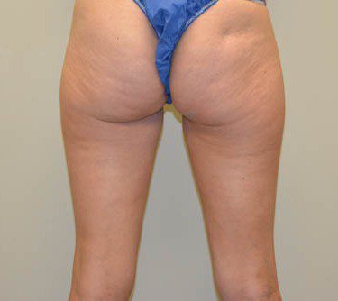 Liposuction Before Patient 2