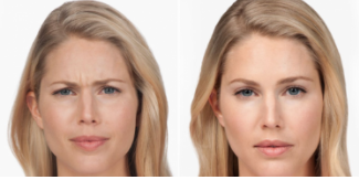 Woman's Botox® Cosmetic Before and After Photos