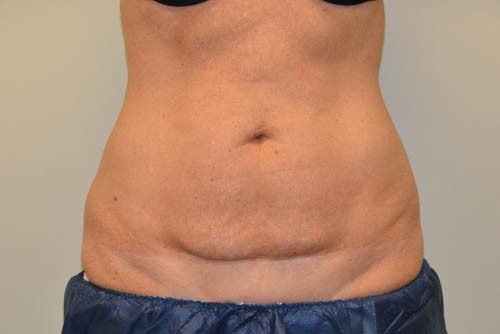 Tummy Tuck Before Patient 1