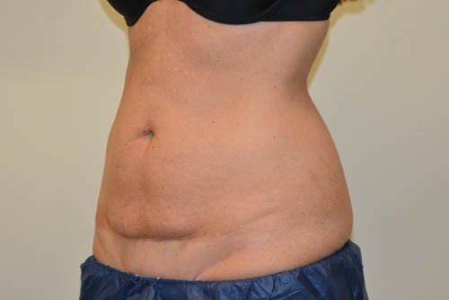 Tummy Tuck Before Patient 4