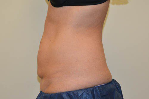 Tummy Tuck Before Patient 5