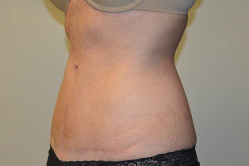 Tummy Tuck After Patient 4