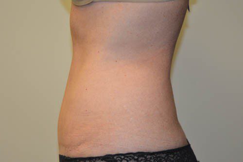 Tummy Tuck After Patient 5