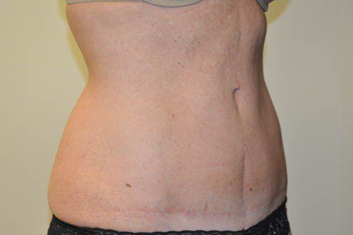 Tummy Tuck After Patient 2