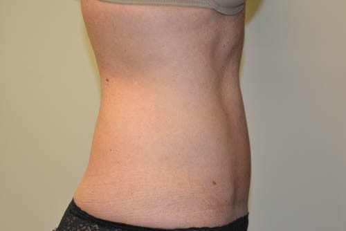 Tummy Tuck After Patient 3