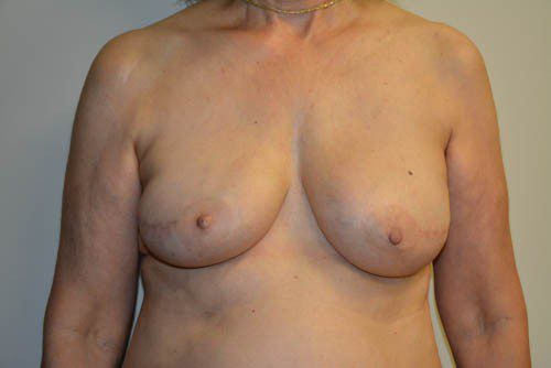 Breast Reconstruction Tissue Expanders After Patient 1