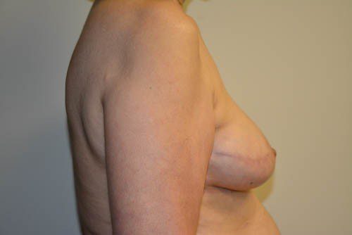 Breast Reconstruction Tissue Expanders After Patient 5