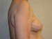 Breast Reconstruction Tissue Expanders After Patient Thumbnail 5