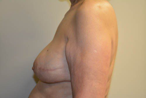 Breast Reconstruction Tissue Expanders After Patient 3