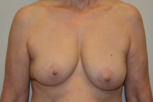 Breast Reconstruction Tissue Expanders Before Patient 1