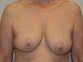 Breast Reconstruction Tissue Expanders Before Patient Thumbnail 1