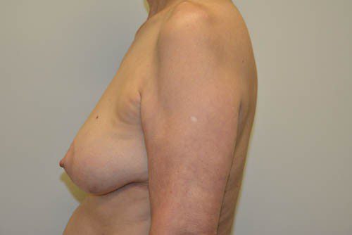 Breast Reconstruction Tissue Expanders Before Patient 3