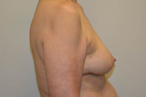 Breast Reconstruction Tissue Expanders Before Patient 5