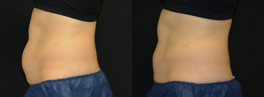 Coolsculpting before and after patient by Dr. Doezie