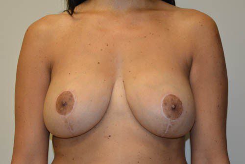 Breast Augmentation w/Lift After Patient 1