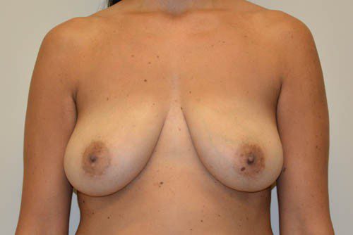 Breast Augmentation w/Lift Before Patient 1