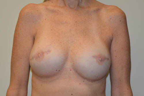 Breast Reconstruction Tissue Expanders After Patient 1