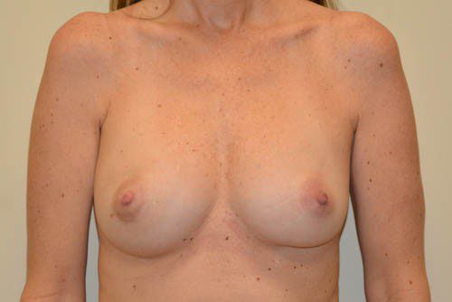 Breast Reconstruction Tissue Expanders Before Patient 1