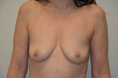 Breast Reconstruction Tissue Expanders Before Patient 1