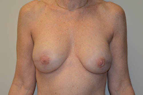 Breast Reconstruction Tissue Expanders After Patient 1