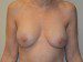 Breast Reconstruction Tissue Expanders After Patient Thumbnail 1