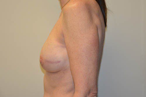 Breast Reconstruction Tissue Expanders After Patient 3