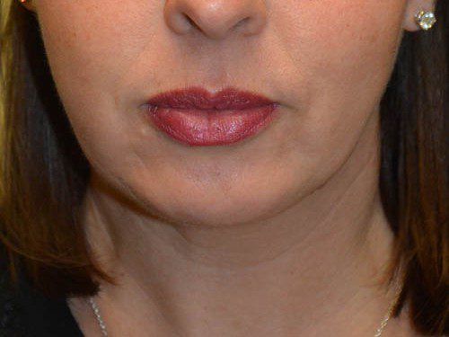 Chin Augmentation After Patient 1