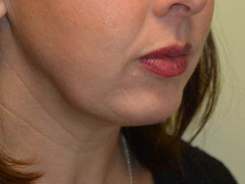 Chin Augmentation After Patient 4