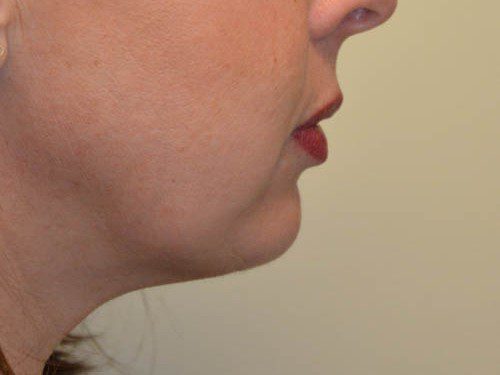 Chin Augmentation After Patient 5