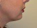 Chin Augmentation After Patient Thumbnail 5