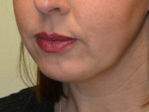 Chin Augmentation After Patient 2
