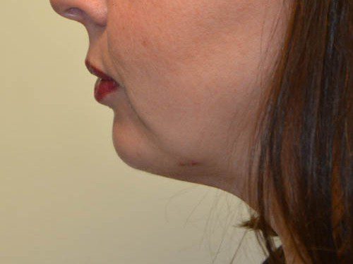 Chin Augmentation After Patient 3