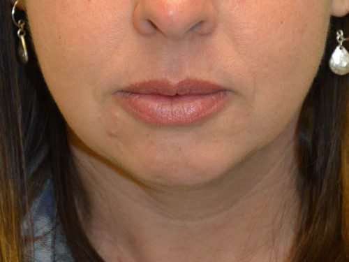 Chin Augmentation Before Patient 1