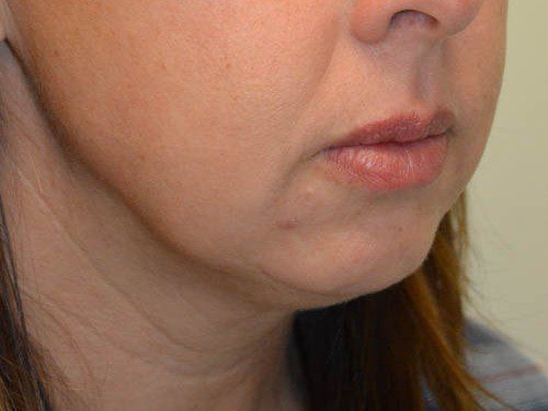 Chin Augmentation Before Patient 4