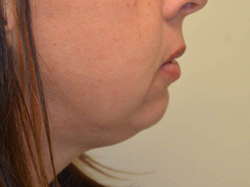 Chin Augmentation Before Patient 5