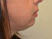 Chin Augmentation Before Patient Thumbnail 5