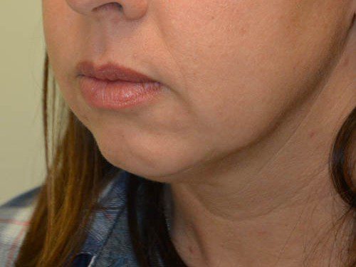 Chin Augmentation Before Patient 2