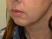 Chin Augmentation Before Patient Thumbnail 2