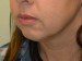 Chin Augmentation Before Patient Thumbnail 2