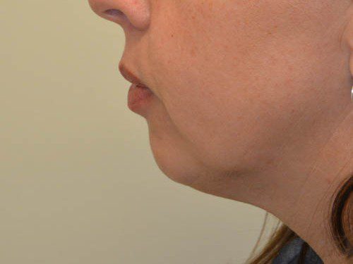 Chin Augmentation Before Patient 3