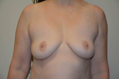 Breast Implant Removal After Patient 1