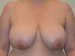 Breast Reduction Before Patient Thumbnail 1