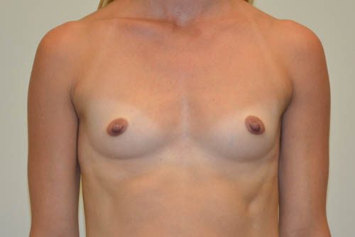 Breast Augmentation Before Patient 1