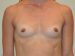 Breast Augmentation Before Patient Thumbnail 1