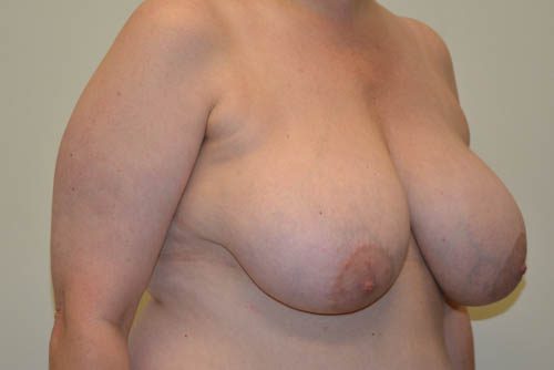 Breast Reduction Before Patient 4