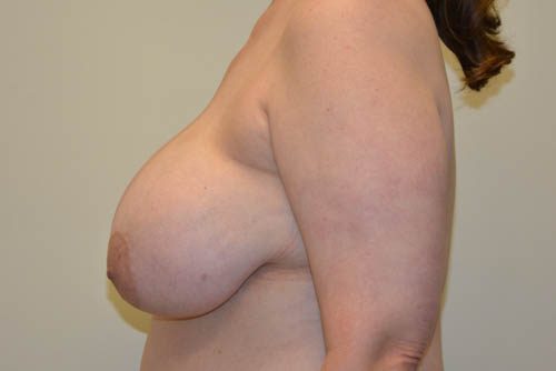 Breast Reduction Before Patient 3