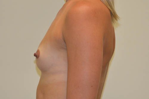 Breast Augmentation Before Patient 5