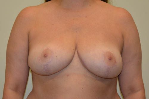 Breast Reduction After Patient 1