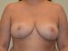 Breast Reduction After Patient Thumbnail 1