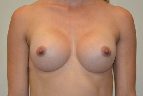 Breast Augmentation After Patient 1